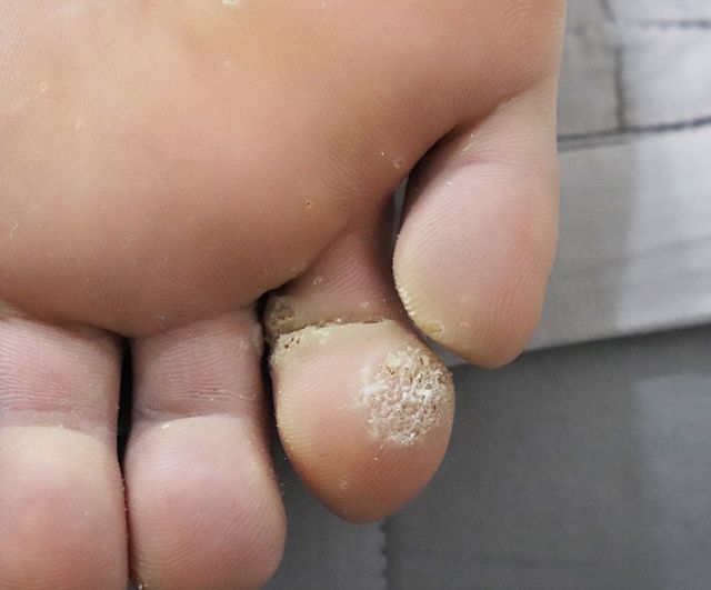 사마귀 치료 전