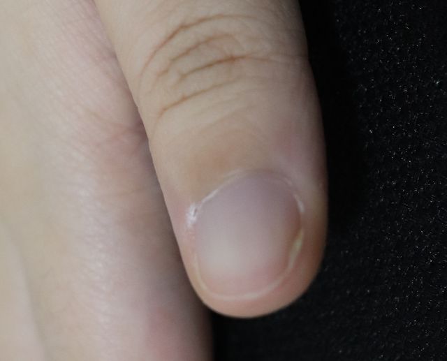 20대 여성 · 8개월 경과