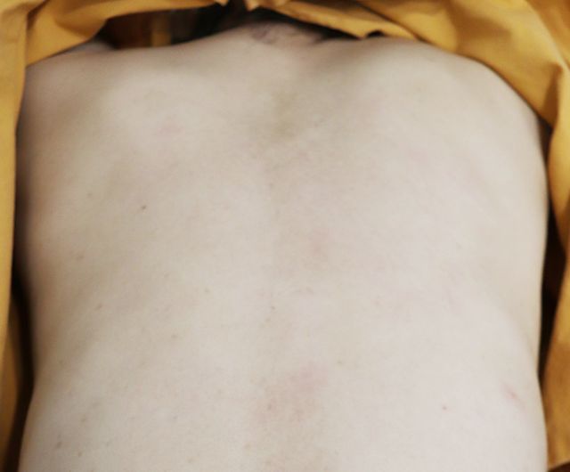 47세 여 · 7개월 경과