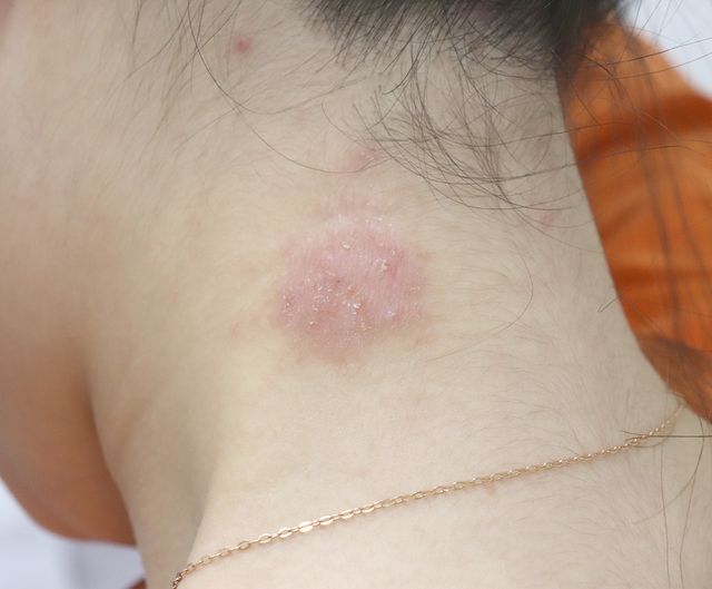 아토피 치료 전