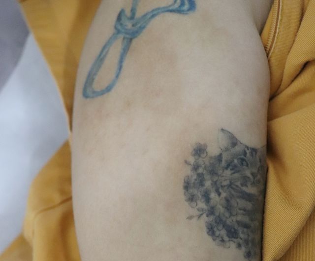 26세 여성 · 9개월 경과