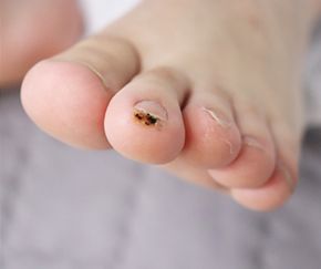 사마귀 치료 전