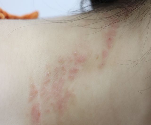 아토피 치료 전