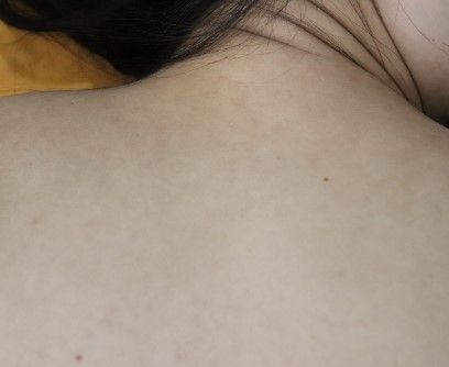 20대  여성 · 9개월 경과